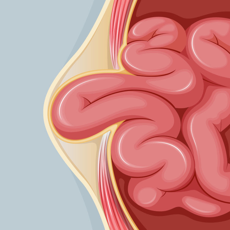 An illustration of a hernia.